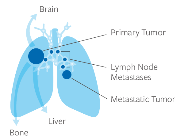 Extensive Stage Lung Cancer