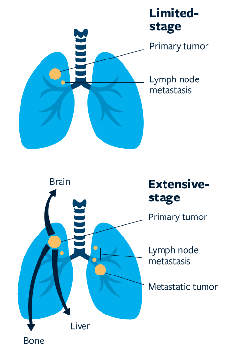 Small Cell Lung Cancer Guide, Understanding SCLC