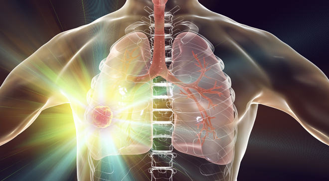 Educated Patient Lung Cancer Webinar focuses on trends, safety, and treatments