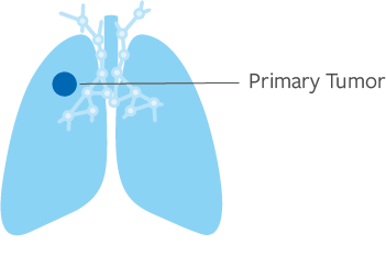Stage 1 Lung Cancer
