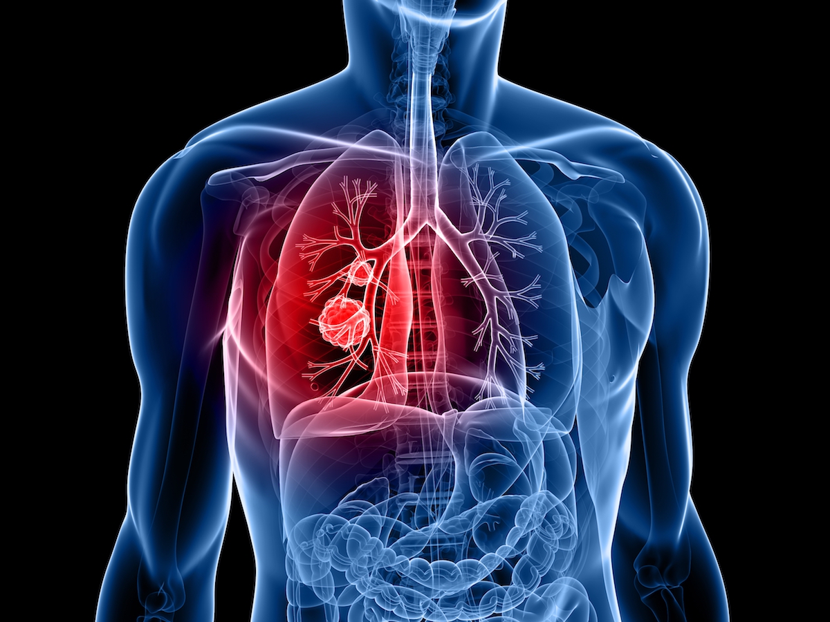 Diagram of Lung Cancer